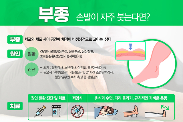 손·발이 자주 붓는다면? 단순 피로 아닌 신장·심장 질환 신호