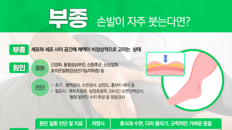 손·발이 자주 붓는다면? 단순 피로 아닌 신장·심장 질환 신호