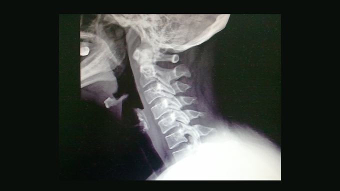 거북목 X-RAY ( (사진 : 우리들한의원)